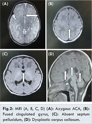 Holoprosencephaly Brain