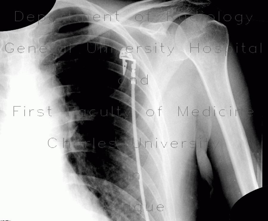 Bone infarct, secondary finding