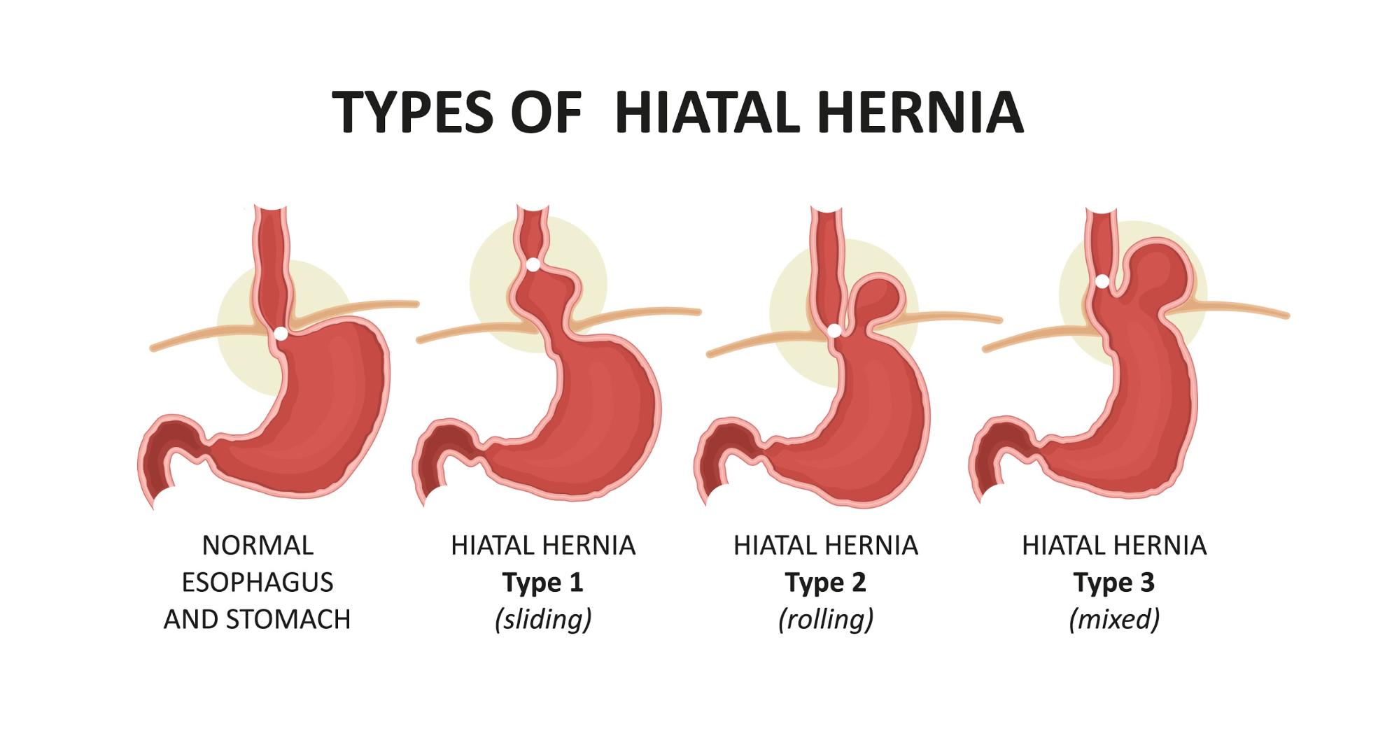 hernia hiatal | Petrus-Maximinus