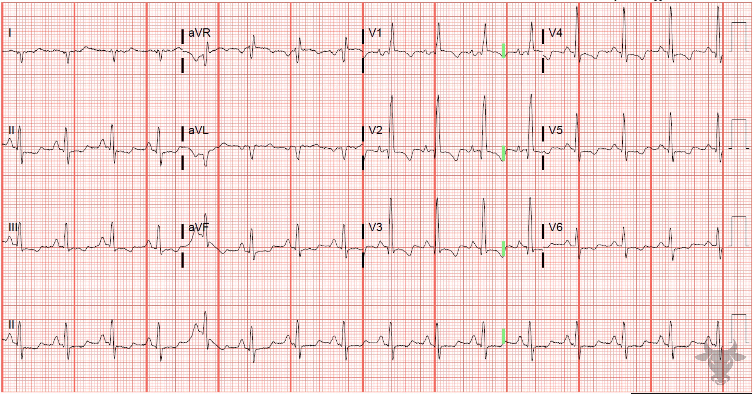 ECG Showing Right Atrial Enlargement