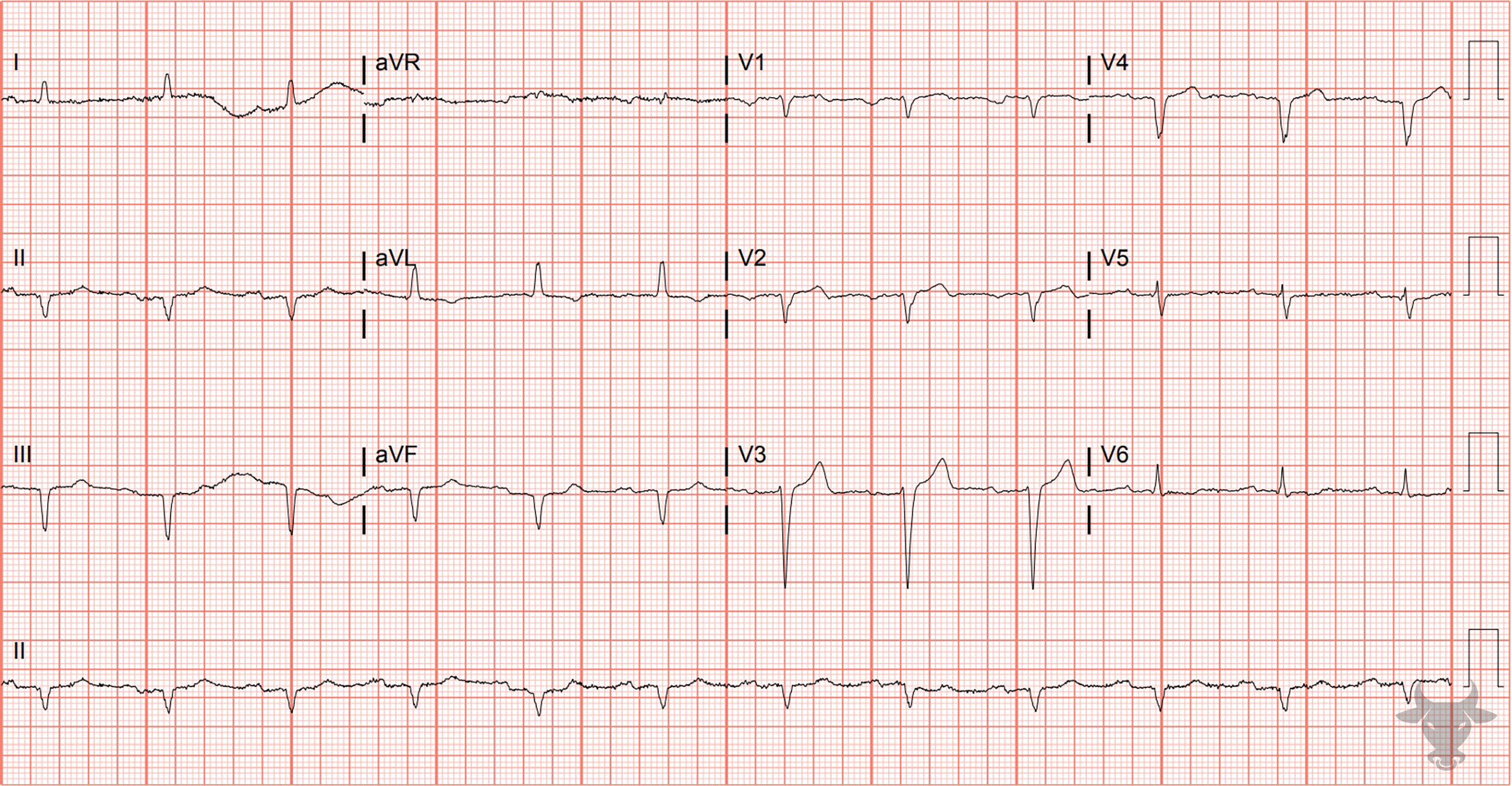 ECG Showing Poor R Wave Progression