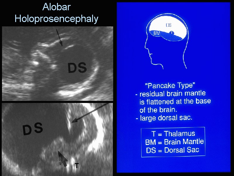 Holoprosencephaly Ultrasound