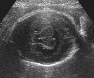 Holoprosencephaly Ultrasound