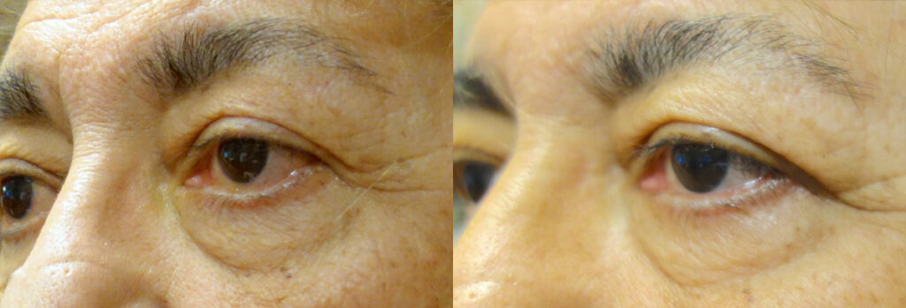 Eyelid Retraction Patient-1