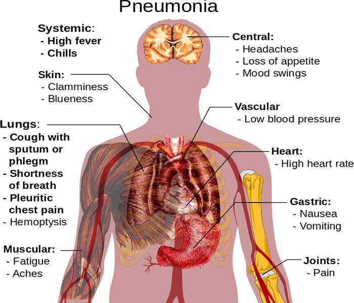 Pneumonia