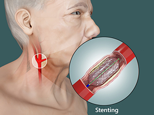 Carotid Stenting