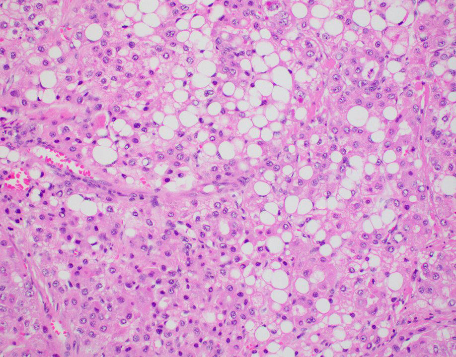 Hepatocellular Carcinoma Histology