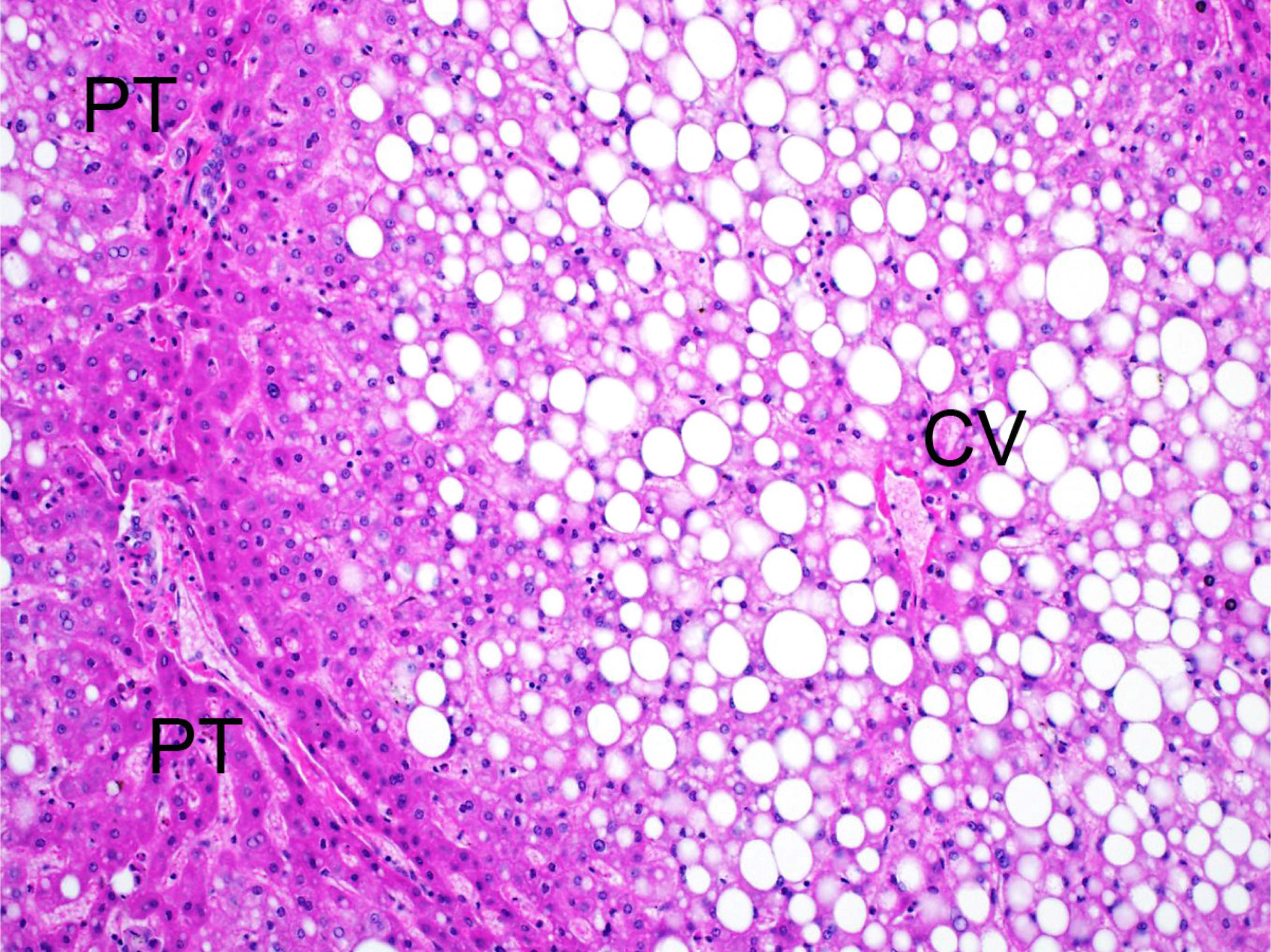 Fatty Liver Histology