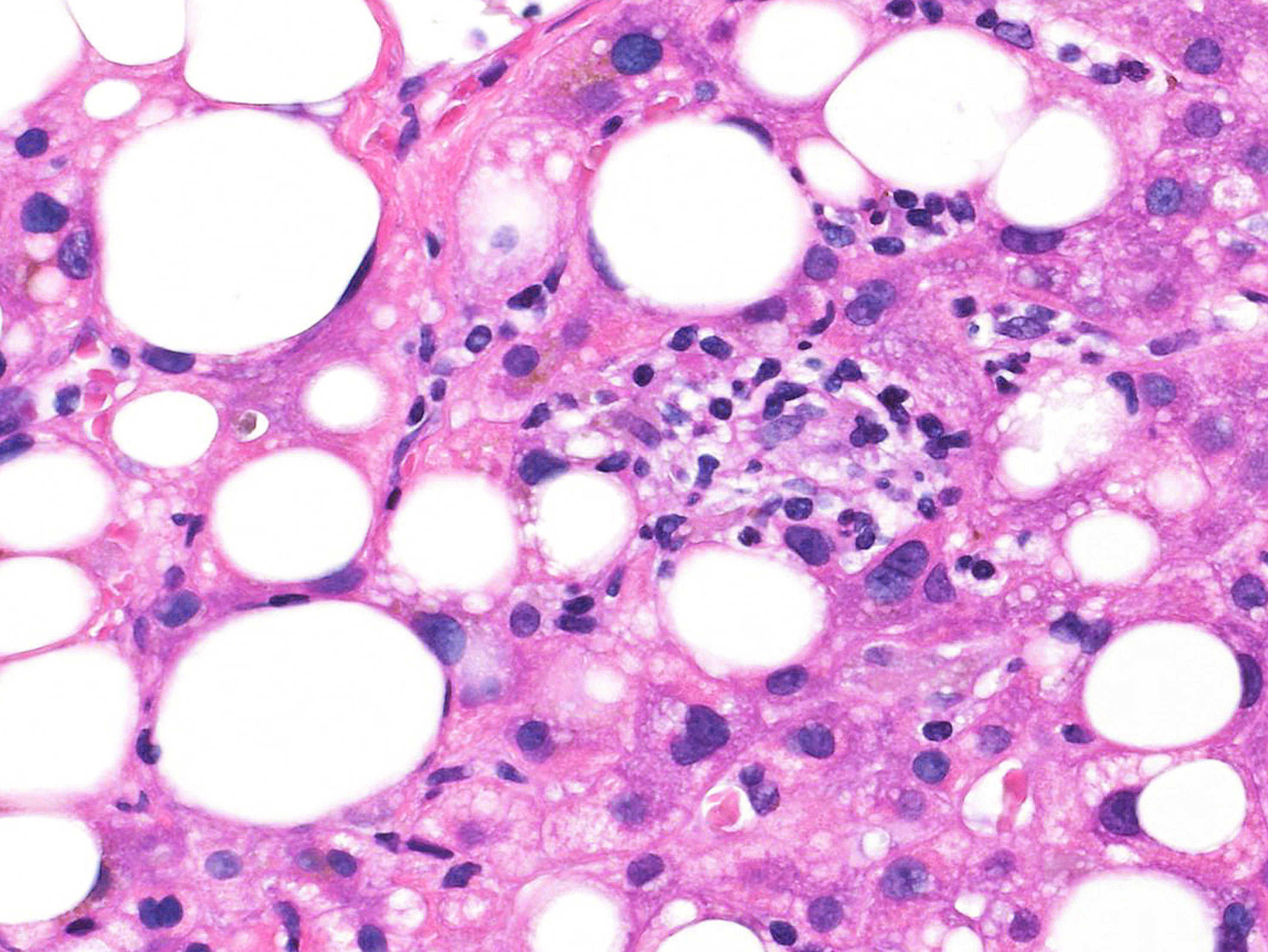 Fatty Liver Histology