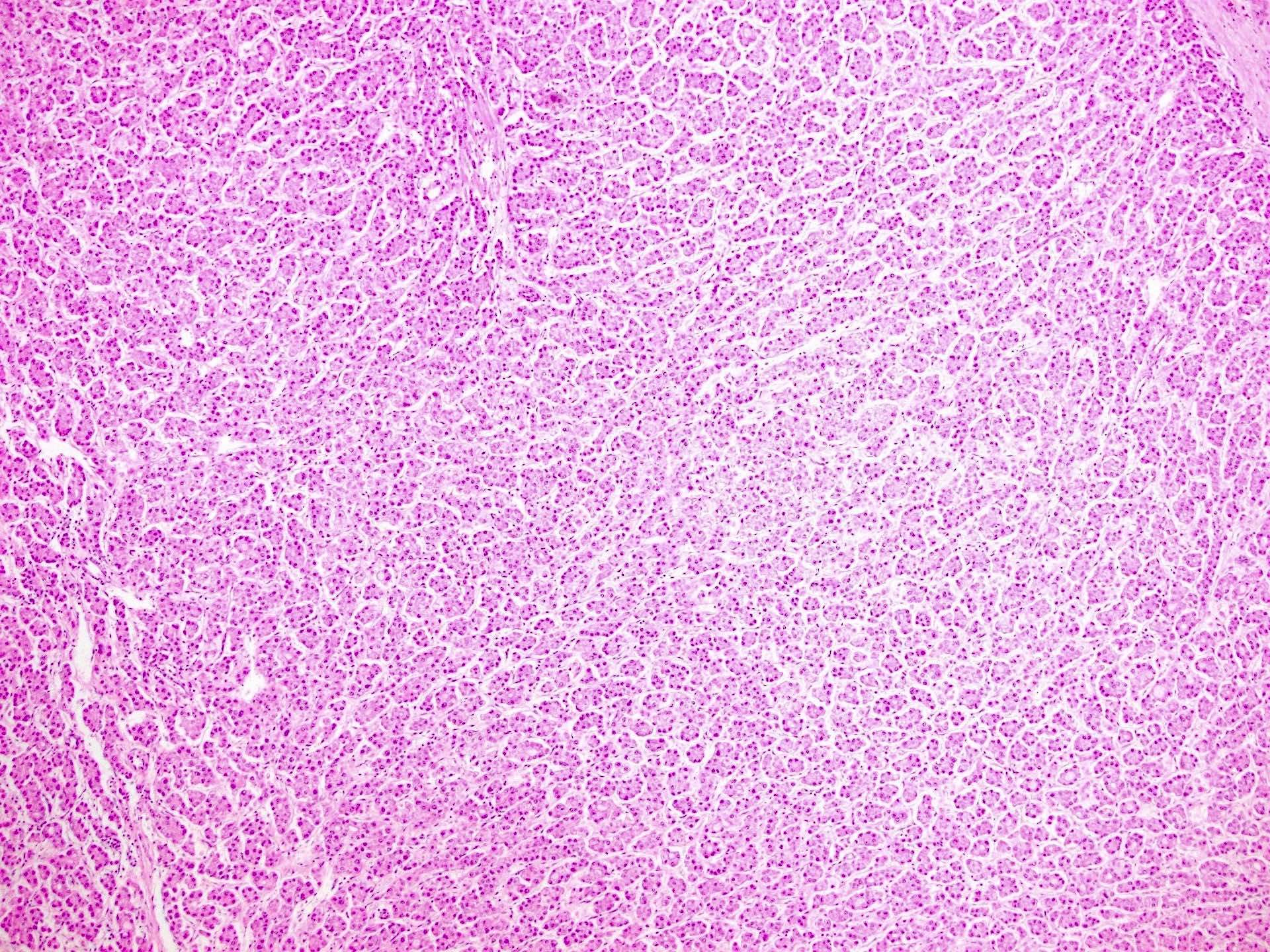 Hepatocellular Carcinoma Histology