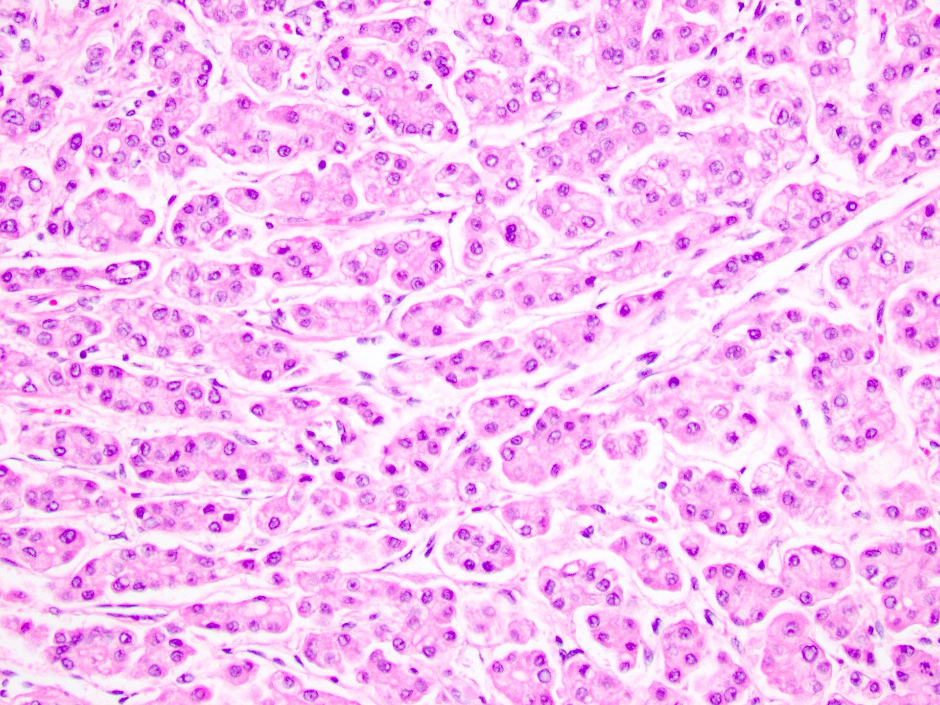 Hepatocellular Carcinoma Histology