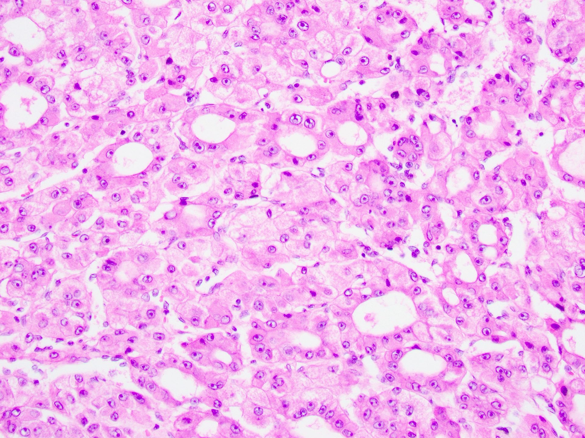 Hepatocellular Carcinoma Gross