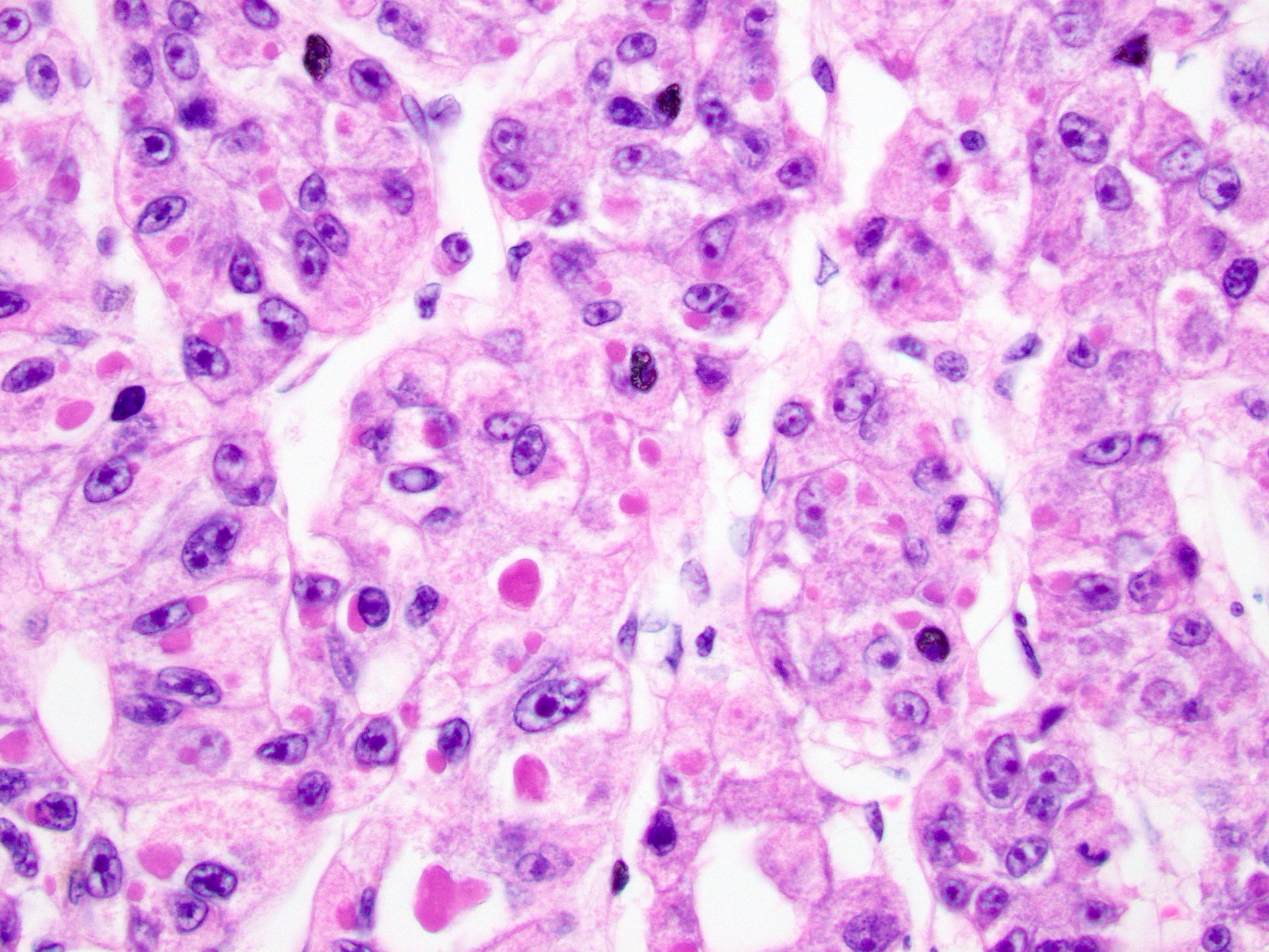 Hepatocellular Carcinoma Histology