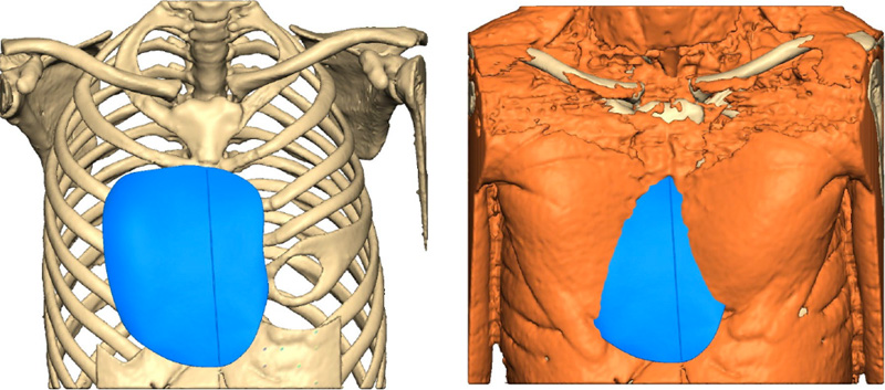 Chest CT scan of pectus implant