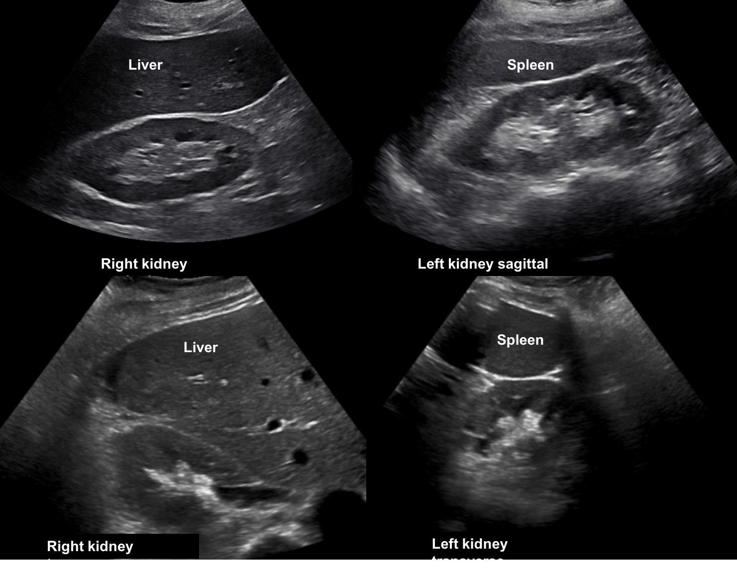 Renal Pyramids Ultrasound