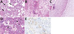 Histologic sections from the placenta of stillborn fetus of a woman with severe acute respiratory syndrome coronavirus 2 infection, Brazil, 2020. Tissue stained with hematoxylin and eosin. A) Placenta shows accelerated villous maturation with increase in syncytial knots. Black arrows indicate small or short hyper mature villi. B) Membranes and basal decidua show decidual arteriopathy, including fibrinoid necrosis with foam cells, mural hypertrophy, absence of spiral artery remodeling, and arterial thrombosis associated with decidual infarct. Asterisks (*) indicate fibrinoid necrosis. C) The umbilical cord shows subendothelial edema and nonocclusive arterial thrombosis, which was also focally observed in a chorionic plate and stem vessels. Asterisks (*) indicate arterial thrombosis. D–E) Photomicrographs show diffuse perivillous fibrin deposition associated with multifocal mononuclear inflammatory infiltrate in the intervillous space and occasional intervillous thrombi. Black arrows indicate fibrin deposition; asterisks (*) indicate mononuclear infiltrate; arrowheads indicate increase in number of Hofbauer cells. E) Immunohistochemical assay using CD68 antibodies highlights histiocyte infiltrate in paraffin-embedded samples (KP1 Clone; Biocare Medical LLC, https://biocare.net).