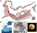 Microscopic analysis of malaria infection in visceral tissue from Medici family, Italy. We evaluated a 2.5 cm × 1.5 cm tissue piece (ID 1297) from 1 jar containing viscera of a Medici family member and identified a potential blood vessel containing erythrocytes. A) Histological cross section of the tissue stained with hematoxylin and eosin; scale bar indicates 200 µm. Inset shows a possible erythrocyte; scale bar indicates 3 µm. B) Giemsa staining of a paraffin section of viscera suggesting the presence of parasites within the erythrocytes. Scale bar indicates 50 µm. C) Atomic force microscopy (AFM) of the tissue section. An optical microscope was used to define appropriate sample areas for AFM imaging (left image); scale bar indicates 20 µm. Enlarged area at right shows a ring stage of Plasmodium falciparum in an erythrocyte; scale bar indicates 2 µm.