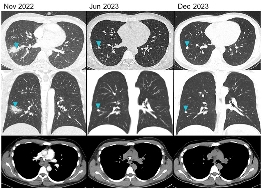 Computed tomography scan findings of a patient with a suspected case of coccidioidomycosis contracted in Peru and the changes in findings seen over 12 months while in treatment in Switzerland, 2022 and 2023. Blue arrows highlight the pulmonary consolidation and regression over time. White arrows highlight the enlarged infracarinal lymphnodes and their regression and normalization over time.