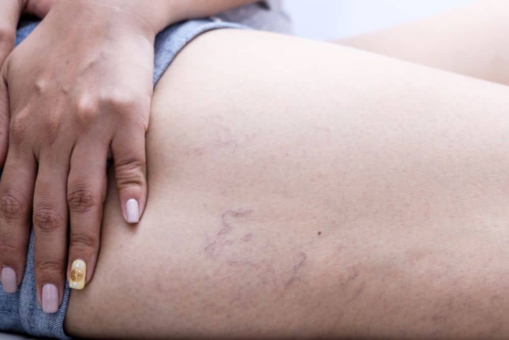 varicose veins on thighs