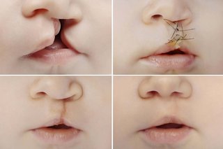 4 images showing changes to a baby’s nose and mouth during cleft lip treatment. First image shows a gap from the top lip up to 1 of the nostrils where 1 side of the nose is lower than the other. Second image shows stiches closing the gap and repairing the nostril. Third image shows a scar from the top lip to the nostril. Fourth image shows a faded scar with repaired cleft lip and the nose looking even on both sides