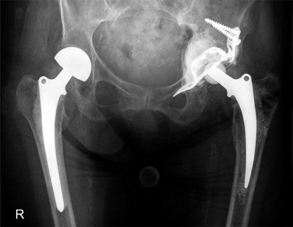 10 Year Survival of Acetabular  Reinforcement Rings Cages  