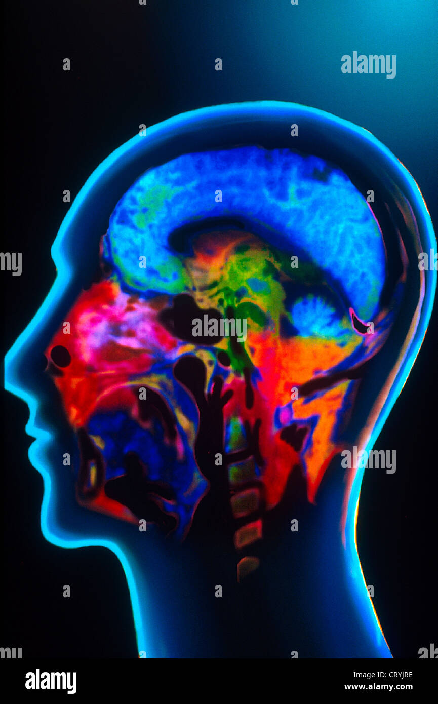 Mri brain scan normal hi-res stock photography and images - Alamy