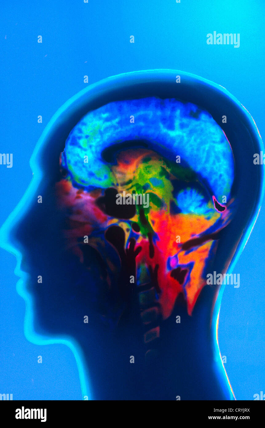 Mri brain scan normal hi-res stock photography and images - Alamy