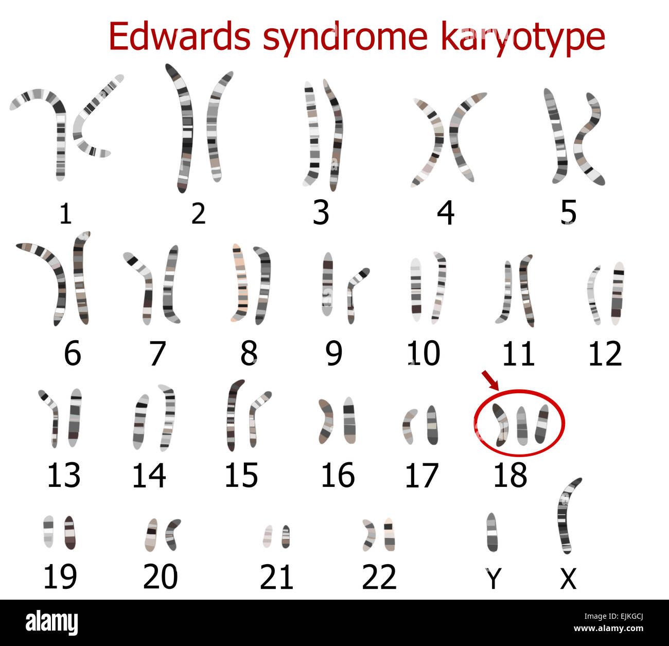 Edwards Syndrome Karyotype | My XXX Hot Girl