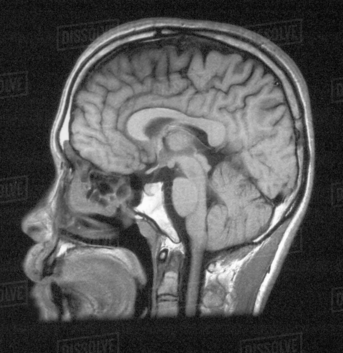 Female Normal MRI Brain