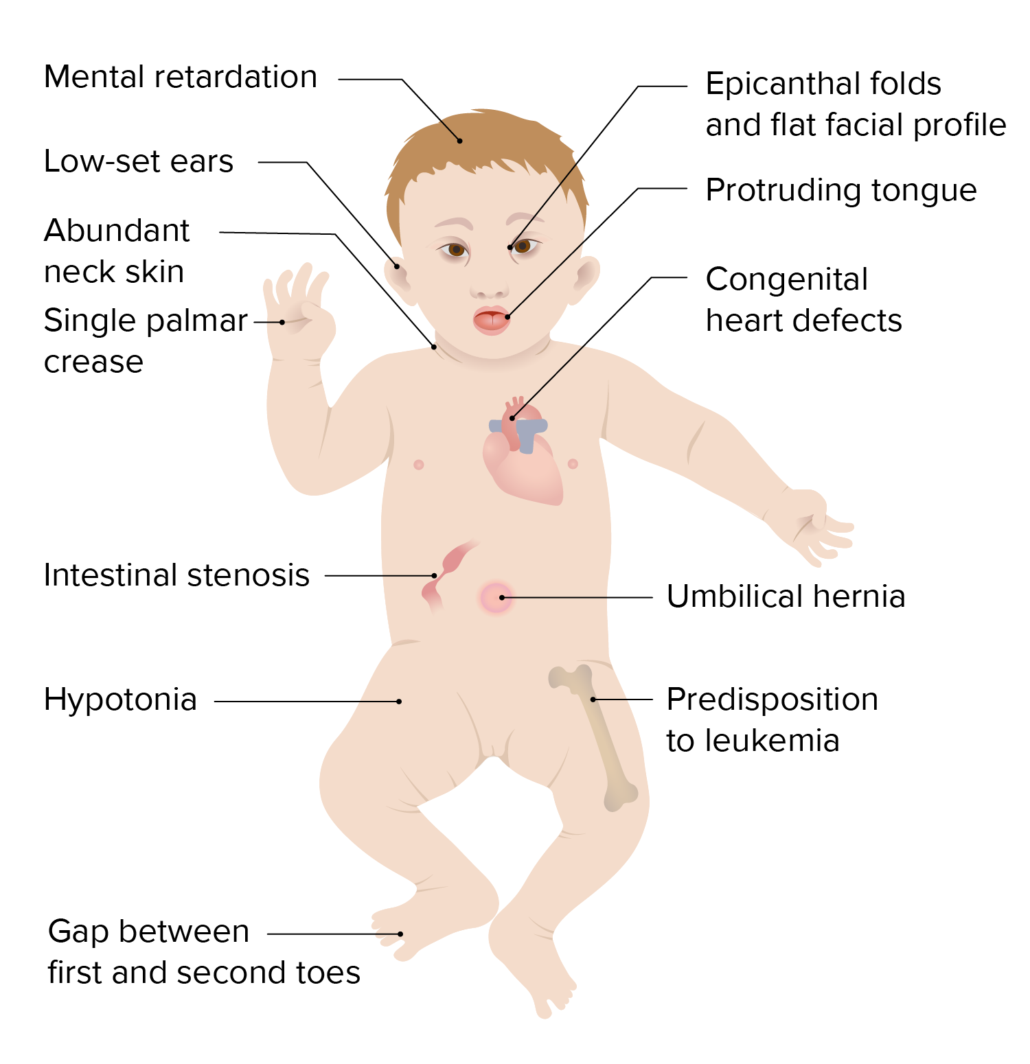 caracteristicas del sindrome de down