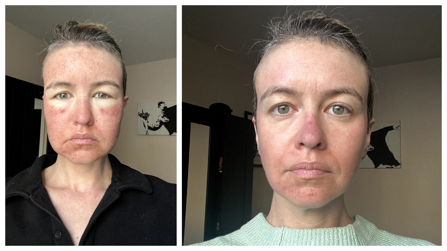 megan mcintyre after laser stacking and healing