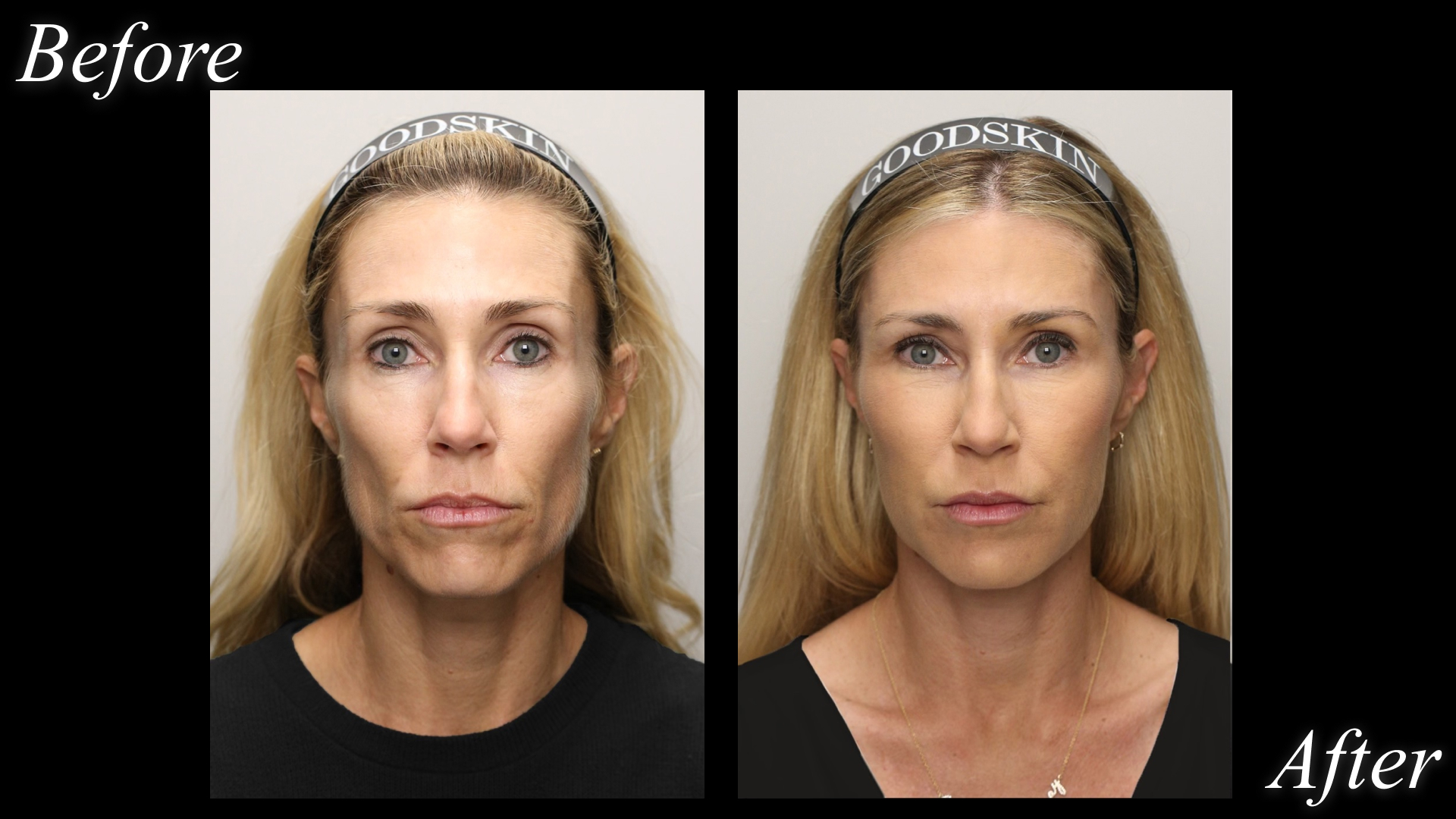 A blonde patient before and after Renuva