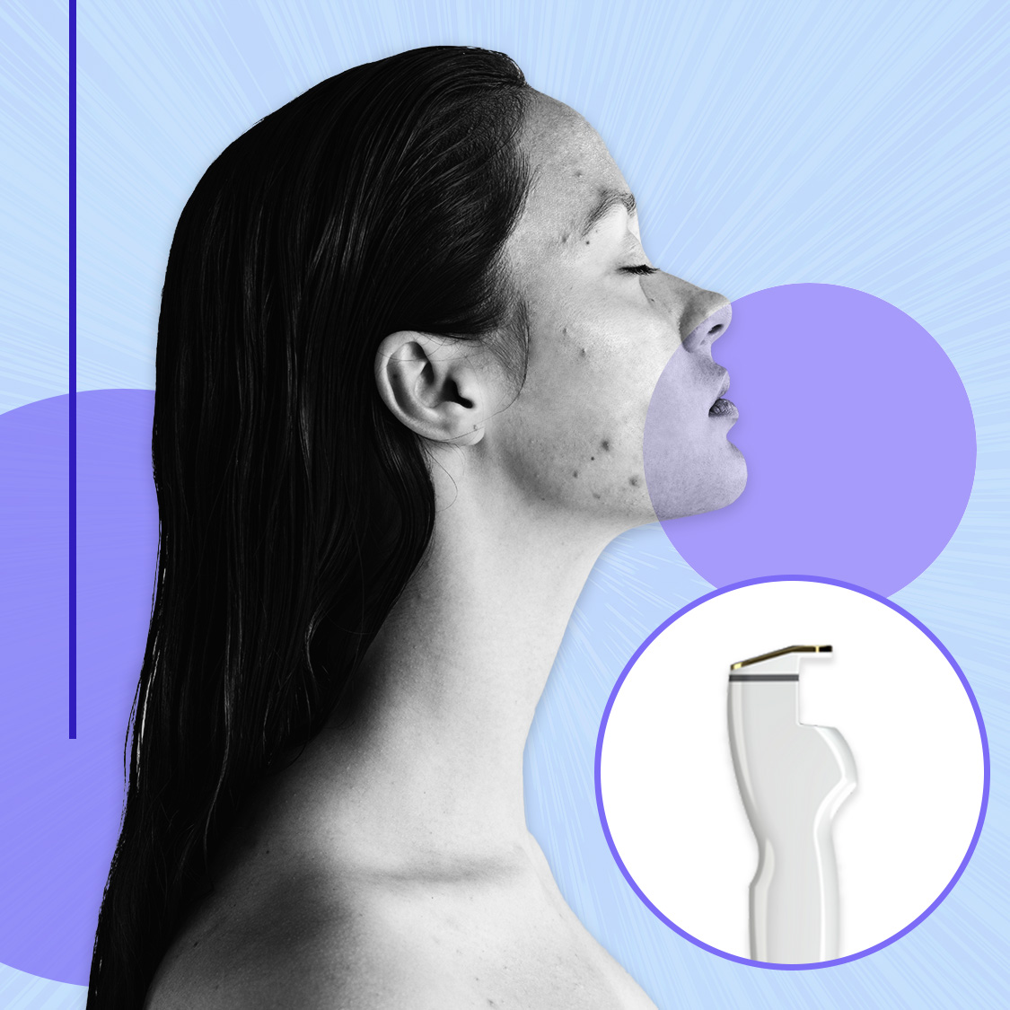 designed graphic of a woman with acne and an image of the aviclear laser device