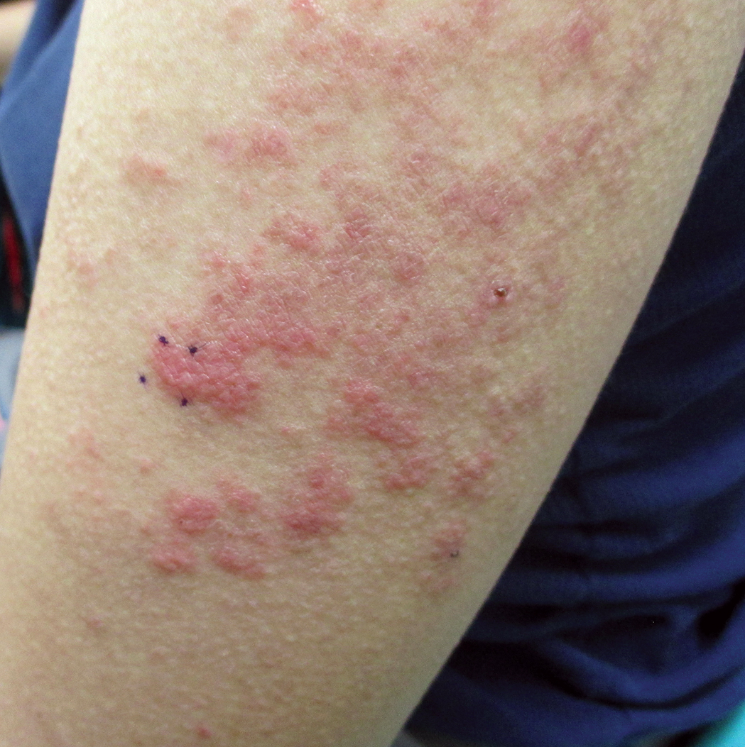 Lupus Rash On Body - vrogue.co