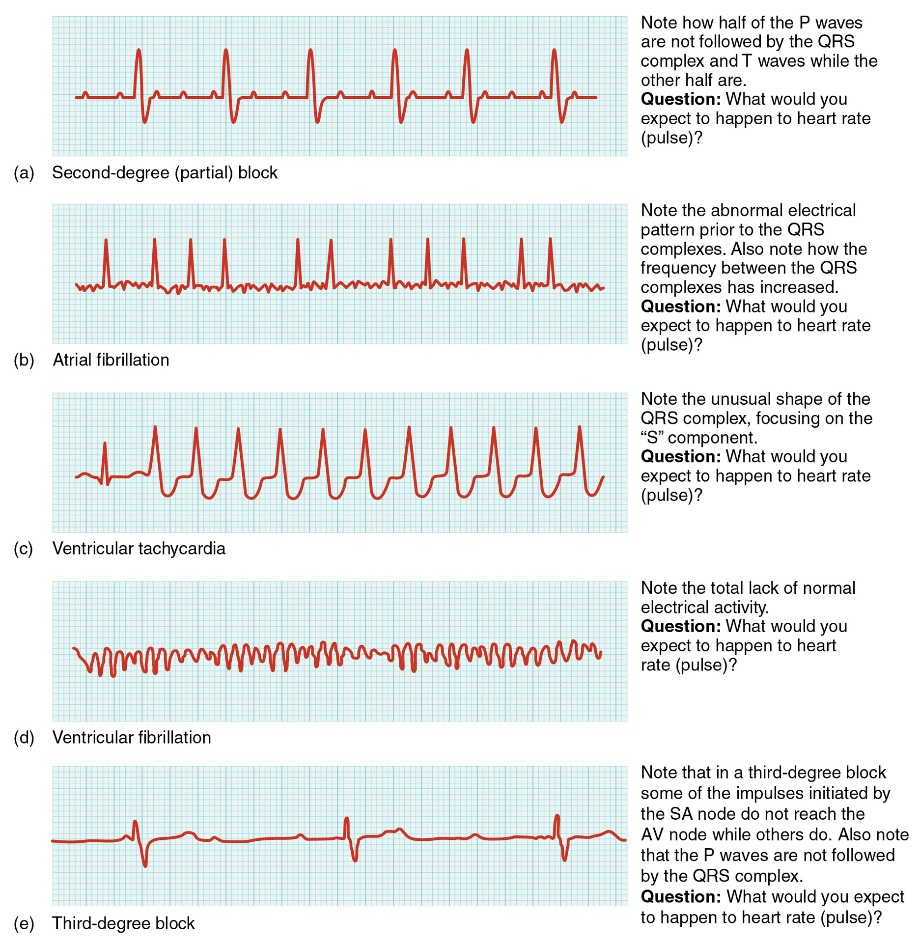 Normal Vs Abnormal Ecg