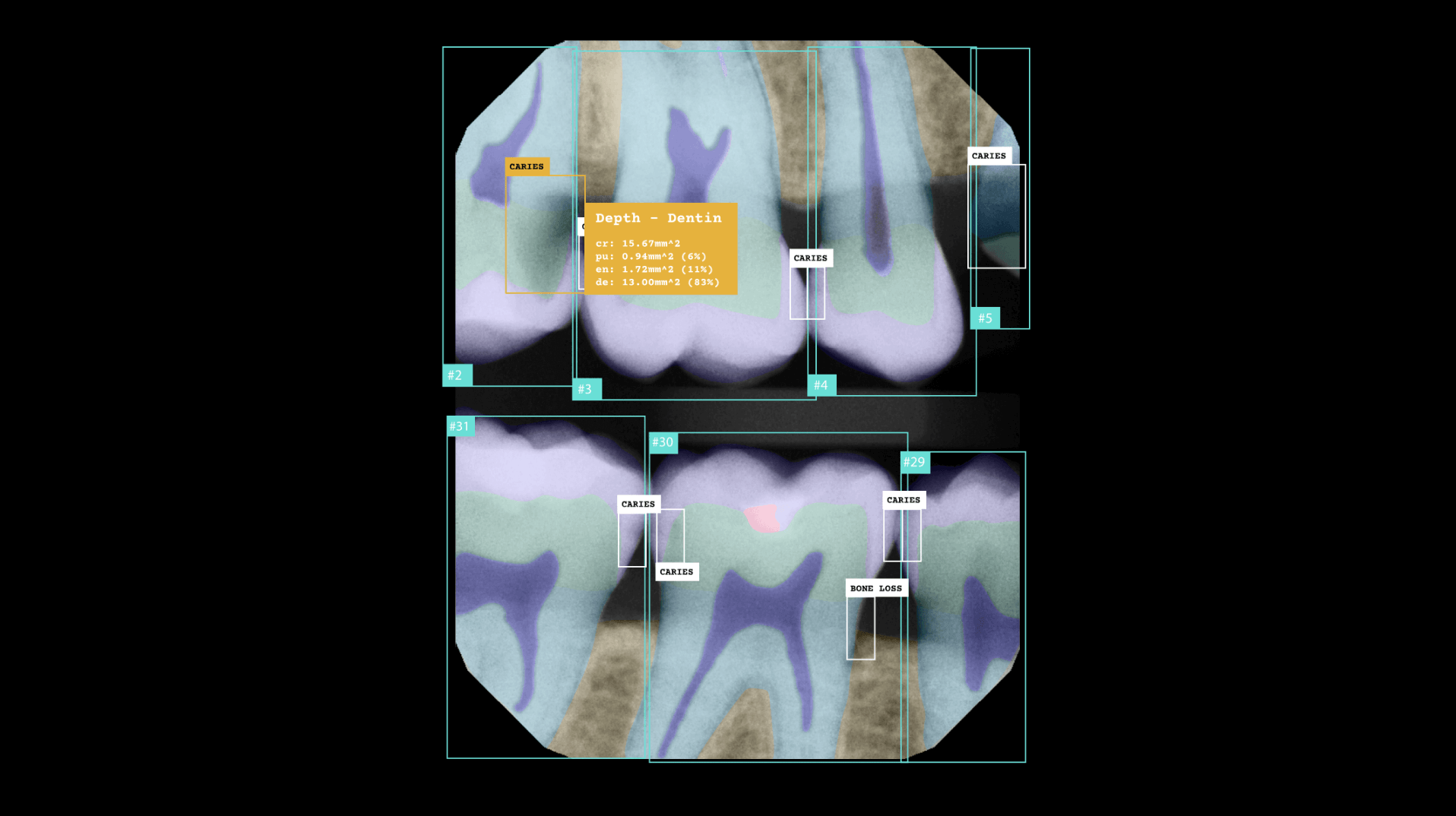 Pearl dental AI segmentation x-ray image