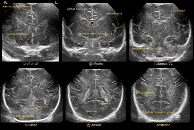 Neonatal Head Ultrasound