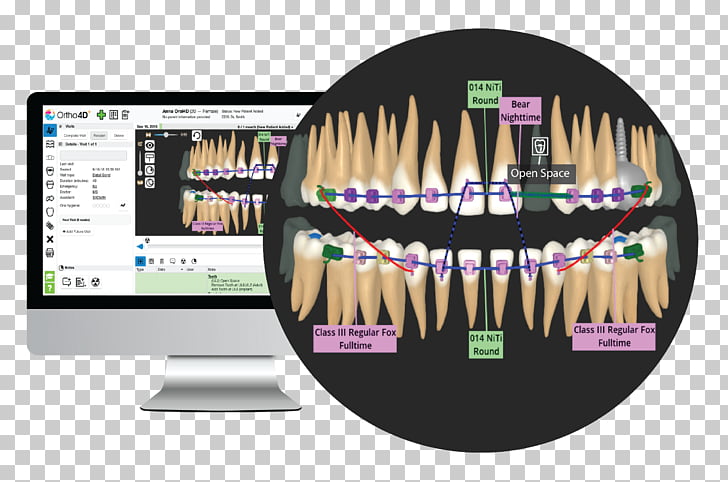 Orthodontics Human tooth Clear aligners Dentistry, 3d dental.