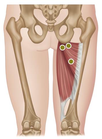 Treating the Hip Adductors.