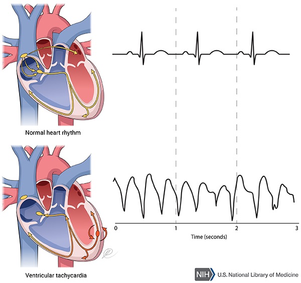 Catecholaminergic polymorphic ventricular tachycardia.