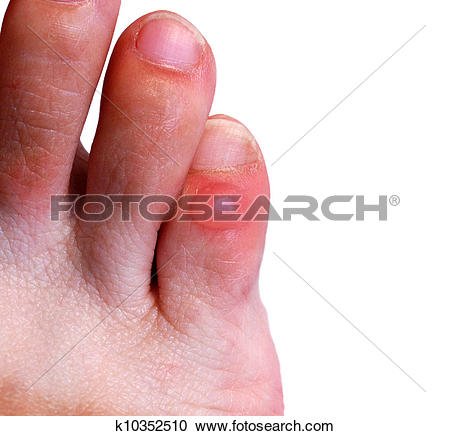 Stock Photography of Blister on little toe k10352510.