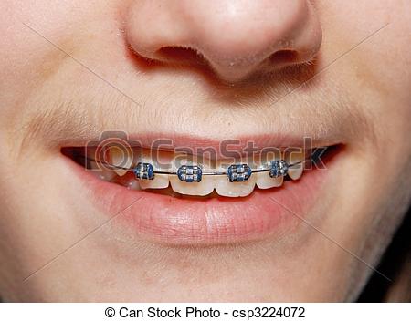 Stock Photo of Braced smile.