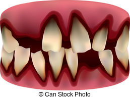 Bleeding Gums Clipart.