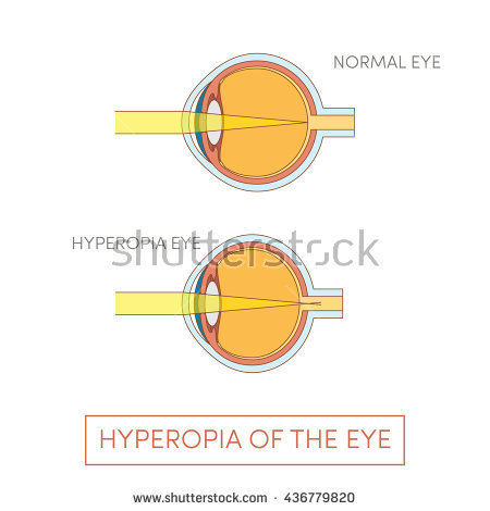 Farsightedness Stock Vectors, Images & Vector Art.