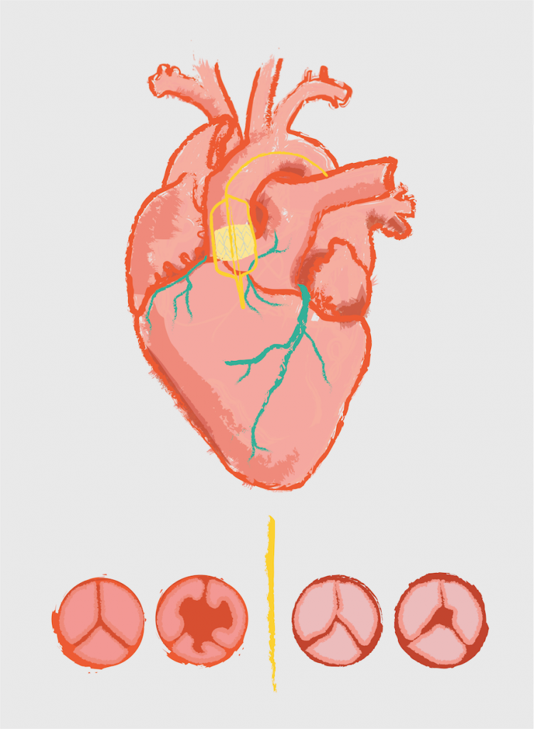 TAVRs: The Minimally Invasive Alternative to Open.