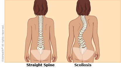 Scoliosis.