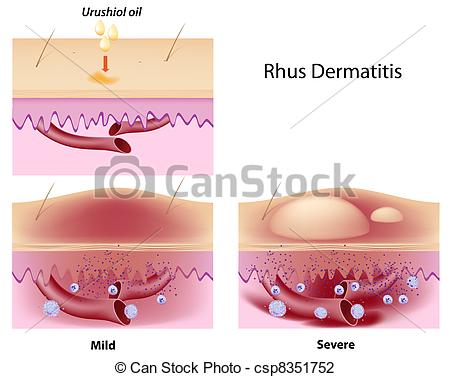 Vector Illustration of Rhus contact dermatitis, eps8.