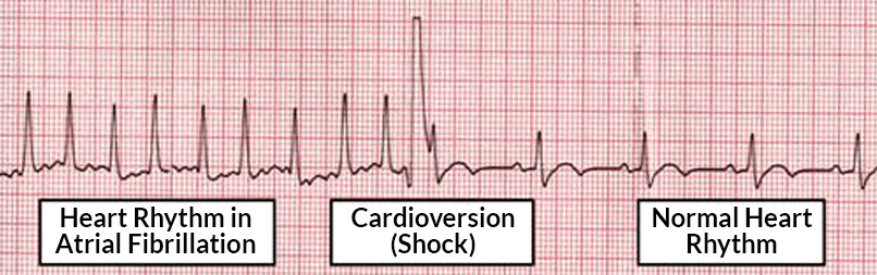 About Synchronized Cardioversion.