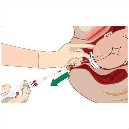 Assisted Vaginal Deliveries