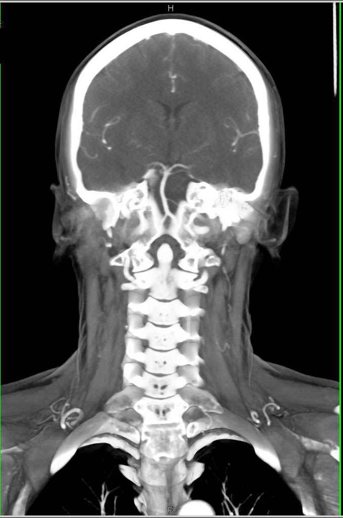 Normal Neck CT Scan